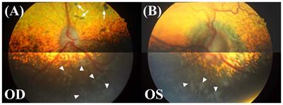 Case report: Unilateral papilledema in a dog with a large suprasellar mass and suspected intracranial hypertension: insights from funduscopy, optical coherence tomography, and magnetic resonance imaging